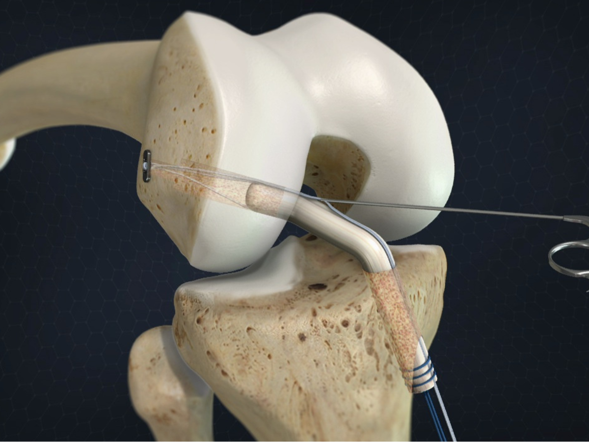 Navigating ACL Reconstruction Recovery Essential Tips For A Seamless 