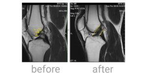 ACL Repair – Non-Surgical Healing| Dr Saurabh Giri