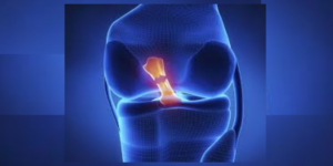 ACL injury
