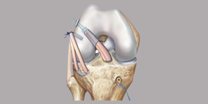 nterolateral Ligament (ALL) Internal Brace