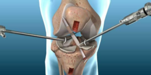 ACL Avulsion Repair – Preserving Your Natural ACL