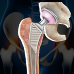 The Science Behind Hip Replacement Revisions: How Surgeons Fix Failed Implants