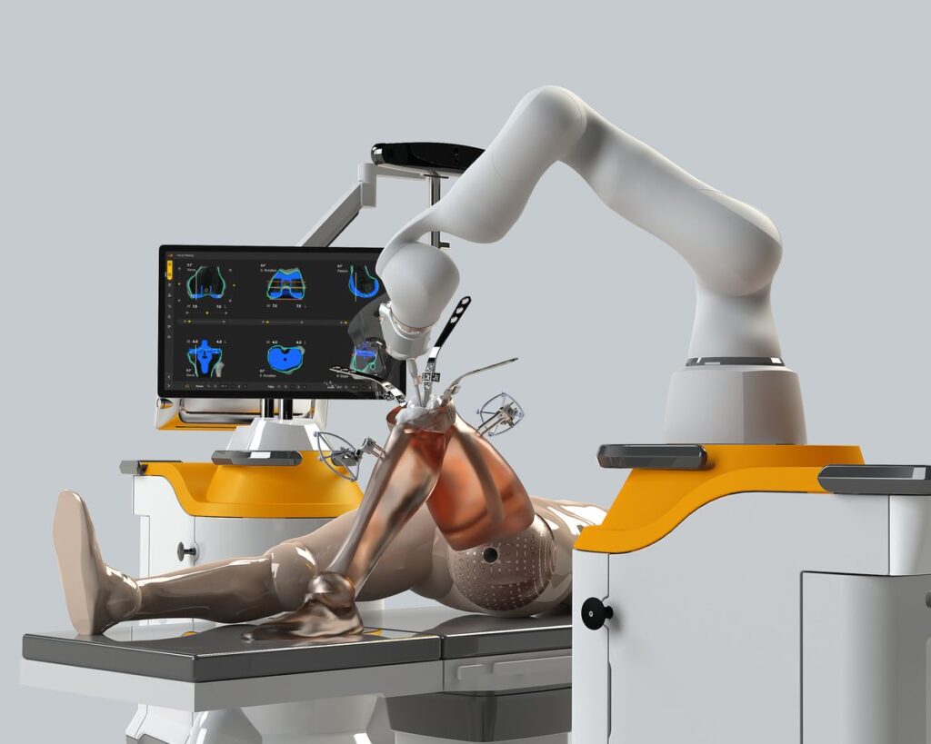Orthopedic surgeon using robotic knee replacement technology for advanced joint replacement surgery.