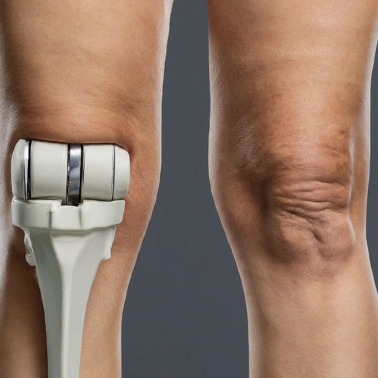 Patient discussing concerns about knee replacement surgery and recovery with an orthopedic surgeon.