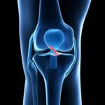 Football player holding injured knee after suffering an ACL tear during sports activity.